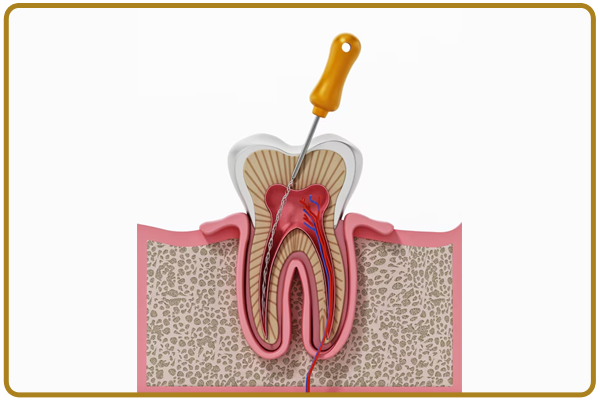 Single Sitting Root Canal Treatment